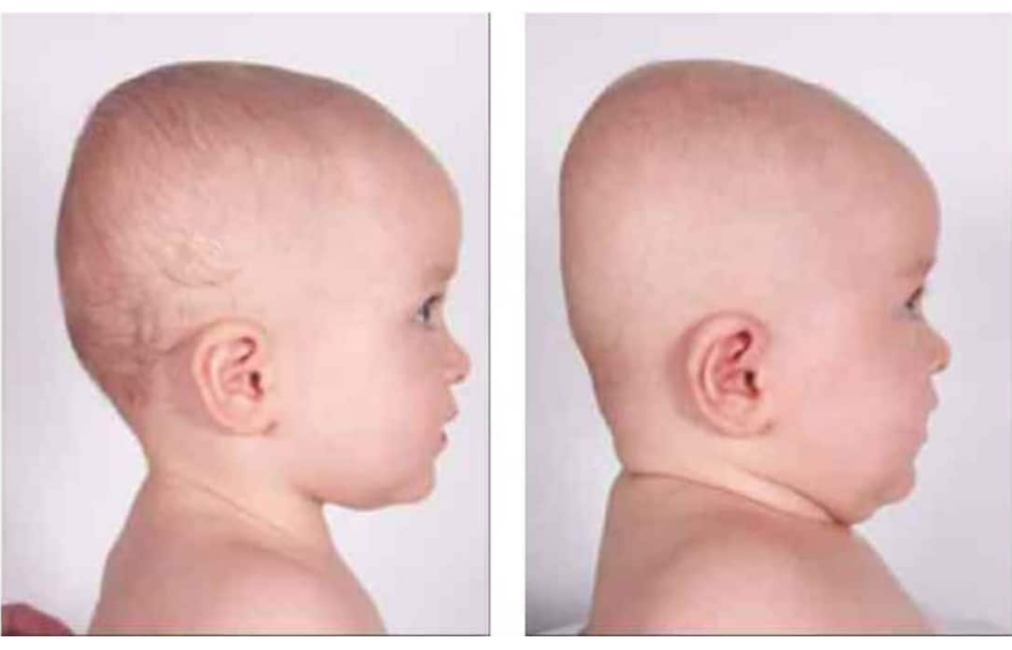 Tipos de deformidades craneales